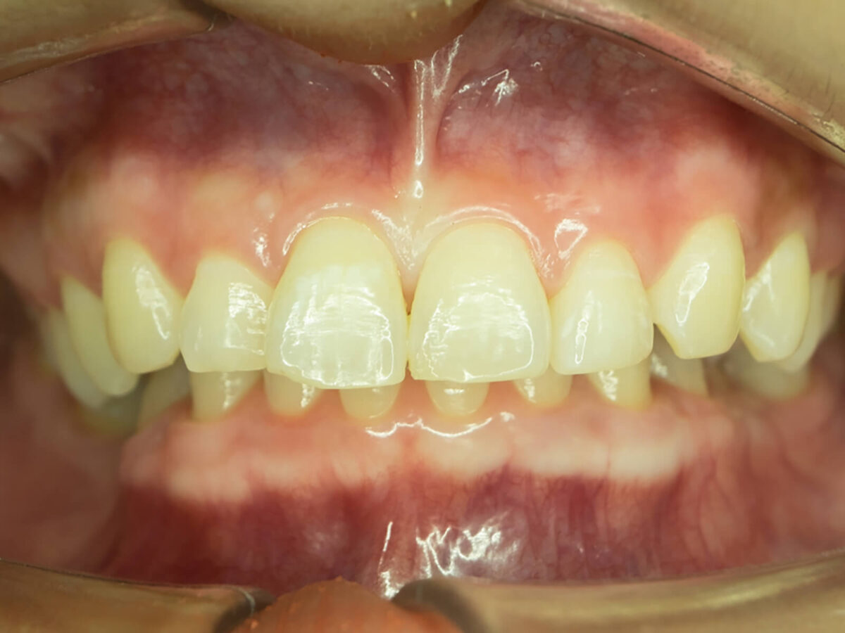 Gingival Pigmentation