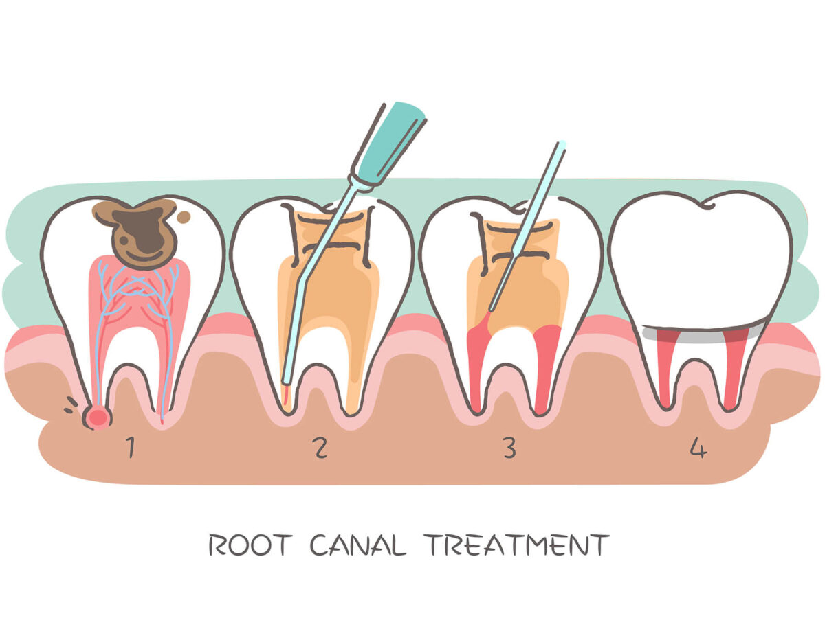 Root Canal Therapy