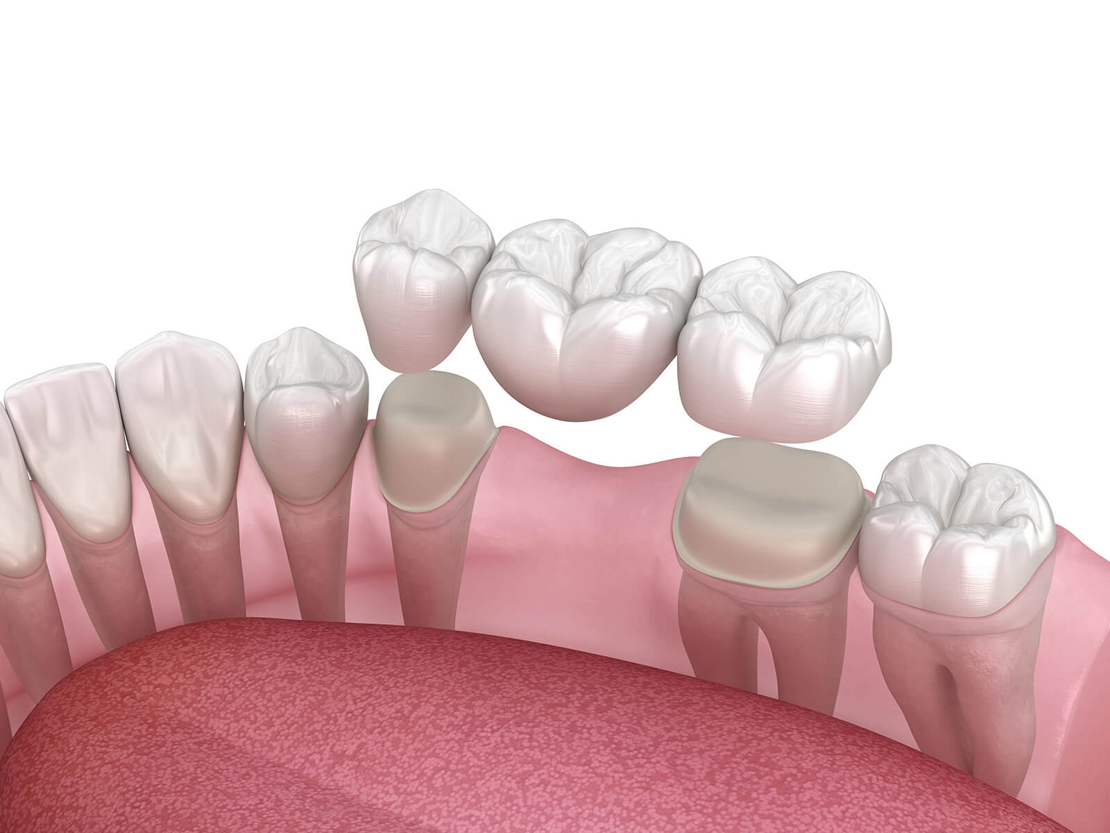 6 Things To Know Before Considering A Dental Bridge