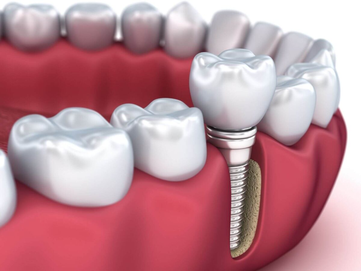 The Advantages of Dental Implants Over Dentures