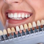 Teeth Whitening Options: Which One Is Best For Your Smile?