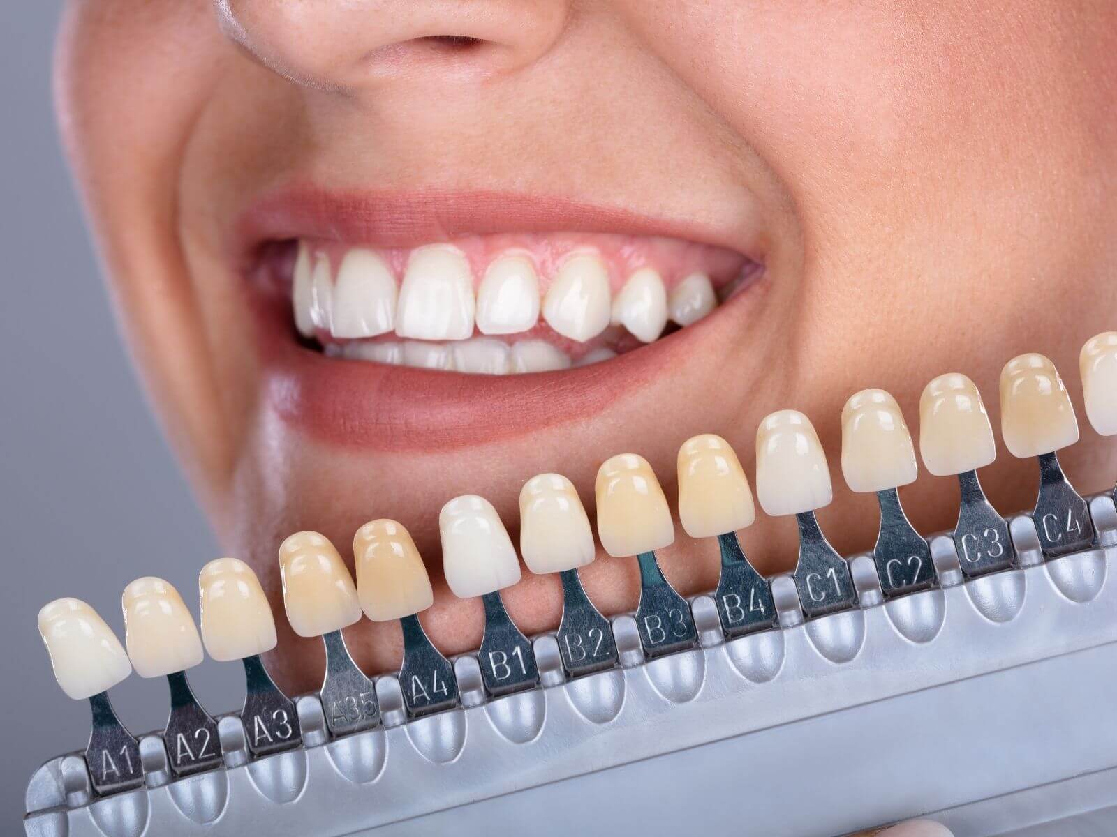 Teeth Whitening Options: Which One Is Best For Your Smile?