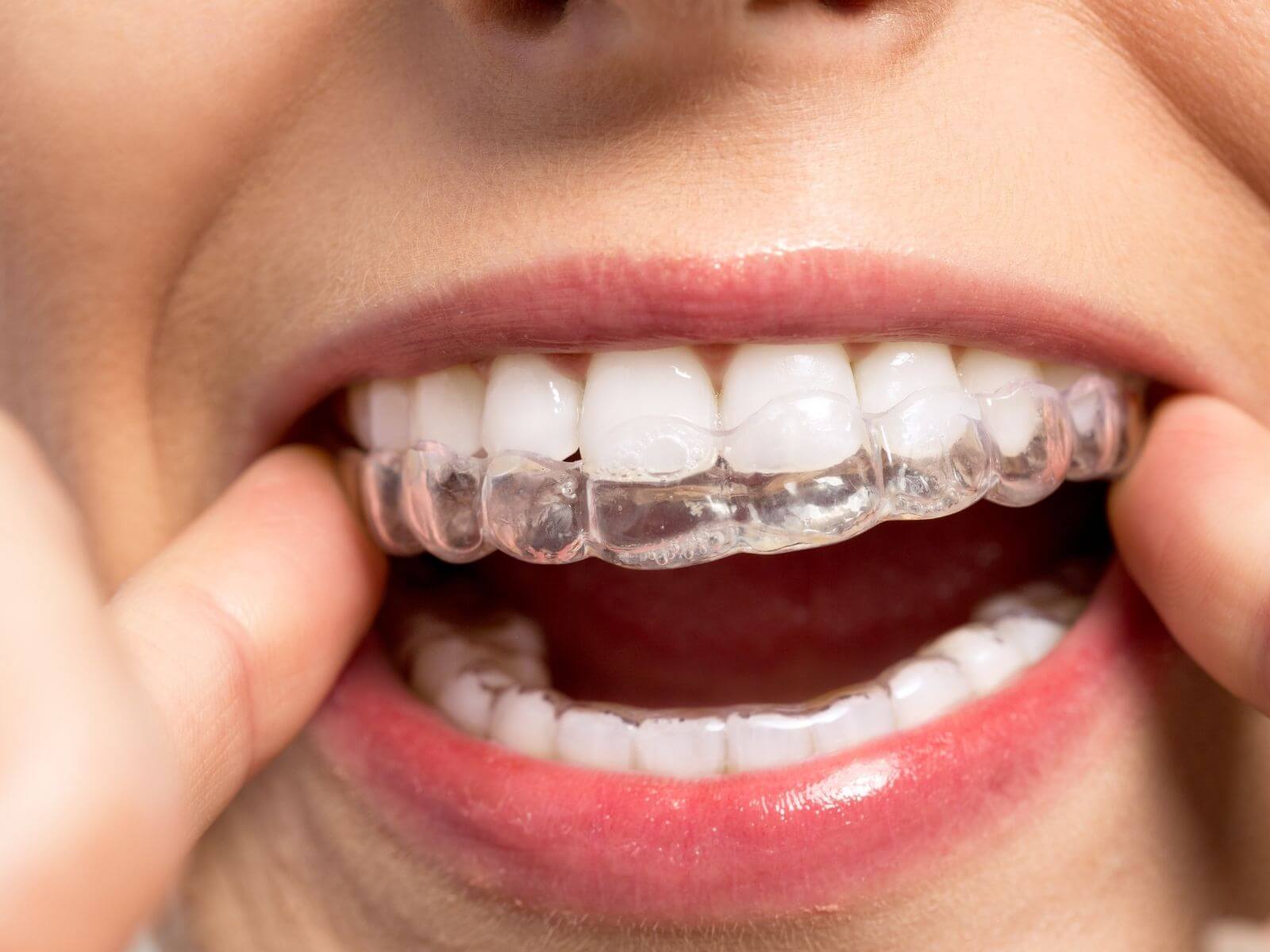 What To Expect After Completing Invisalign Treatment